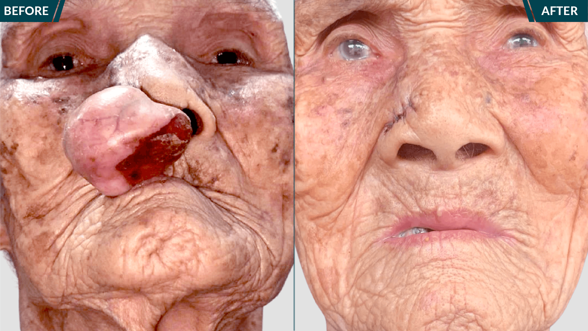 trước và sau cụ khoan được bác sĩ tú dung cắt khối u