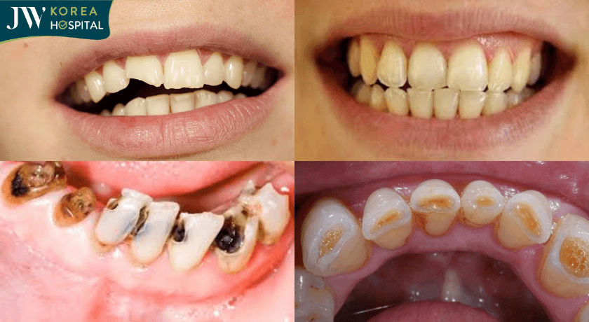 vấn đề răng miệng nên bọc răng sứ