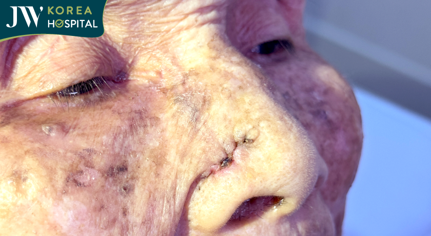 Hình ảnh mới nhất của cụ Khoan sau 7 ngày cắt khối u mạch máu