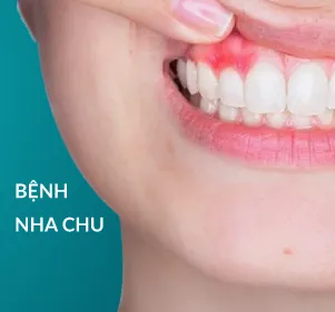 Bệnh nha chu
