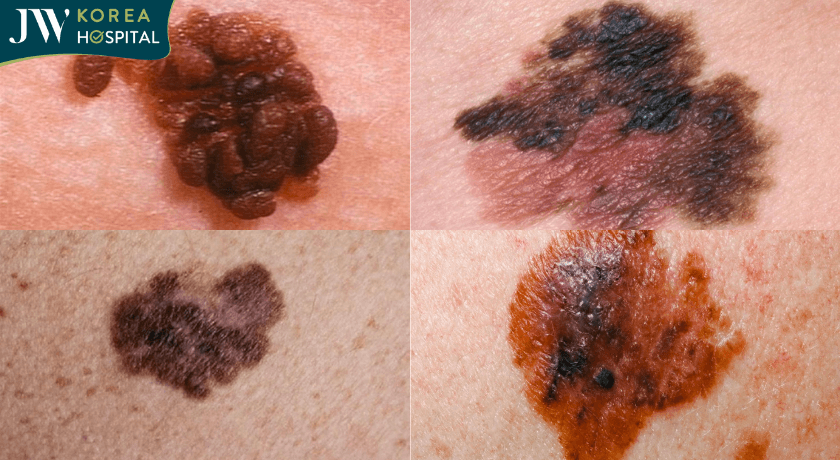các loại hắc tố Melanoma