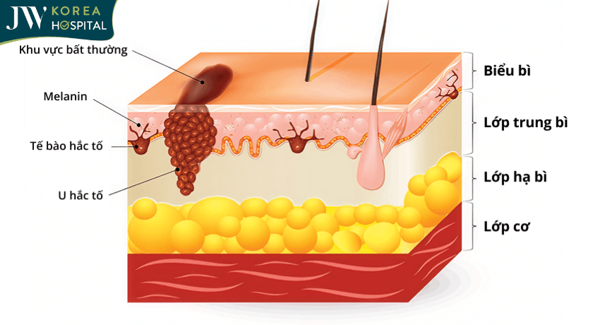 hắc tố melanoma được hình thành như nào