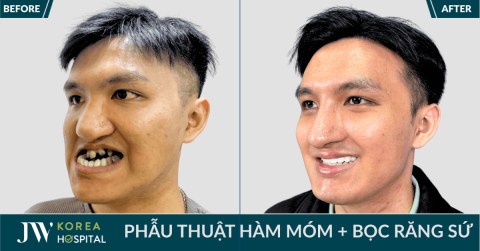 Bị bắt nạt, nam sinh gen Z chi 500 triệu phẫu thuật thẩm mỹ khiến nhiều người hối hận