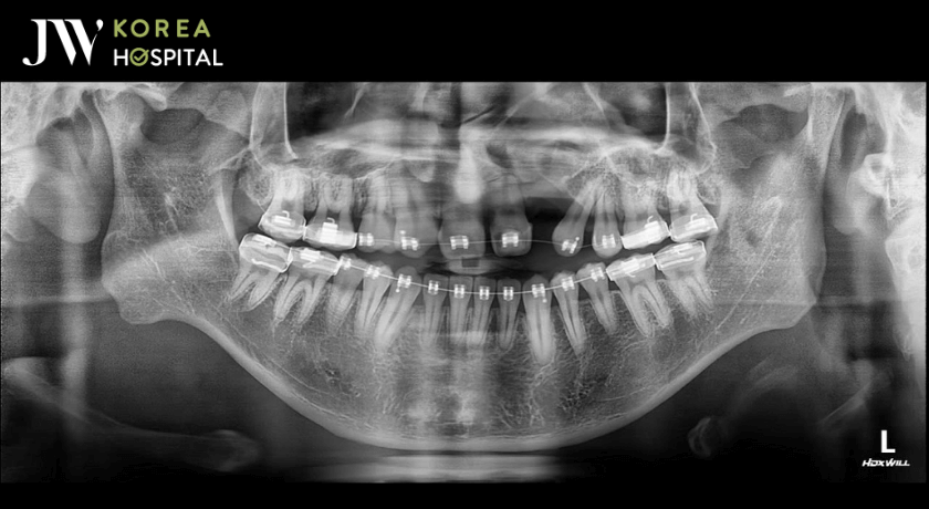Hình chụp X quang niềng răng