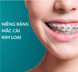 Niềng răng mắc cài kim loại