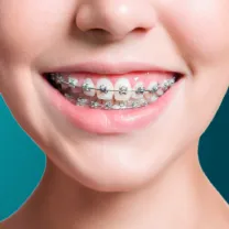 Niềng răng mắc cài kim loại