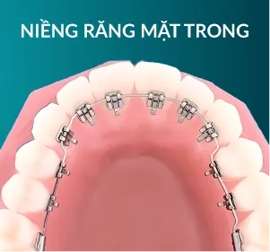 Niềng răng mặt trong