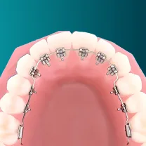 Niềng răng mặt trong