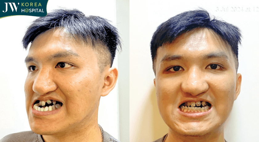 Niềng răng trước khi phẫu thuật hàm