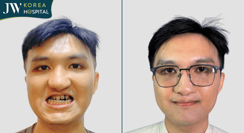 phẫu thuật hàm tại bệnh viện JW