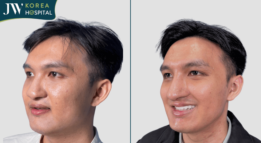 Phẫu thuật hàm niềng răng bọc răng sứ tại Bệnh viện JW