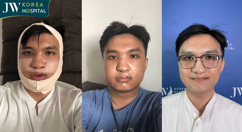 quá trình hồi phục sau khi phẫu thuật hàm tại JW