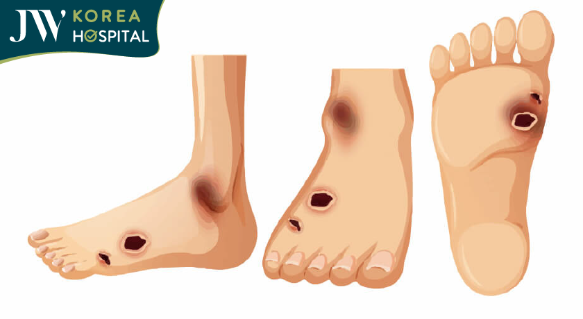 Bệnh đái tháo đường làm lở loét bàn chân và khó lành vết thương