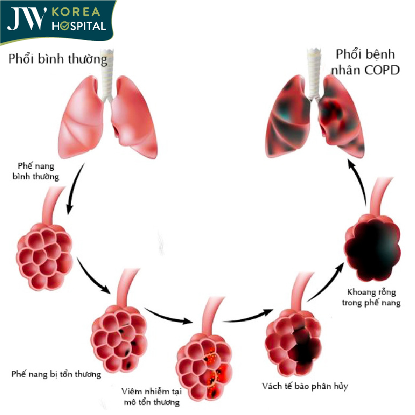 Quá trình mắc bệnh COPD