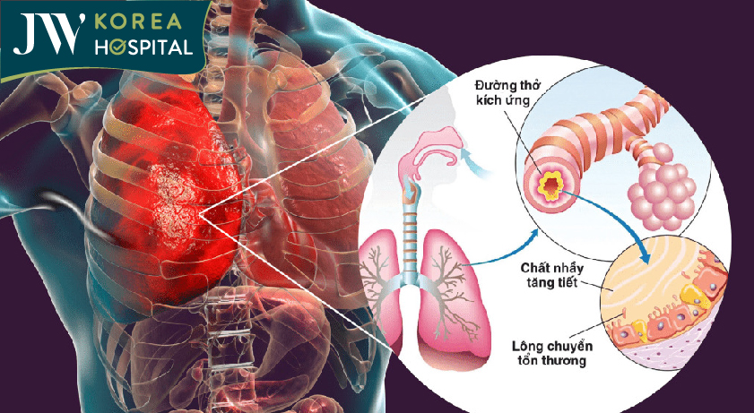 Người bị mắc bệnh COPD sẽ bị tắc nghẽn đường thở