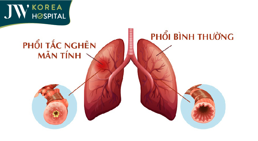 Hình ảnh phổi bị tắc nghẽn mãn tính