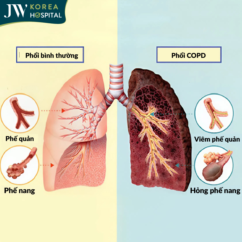 Hình ảnh trước và sau của phổi khi mắc bệnh COPD
