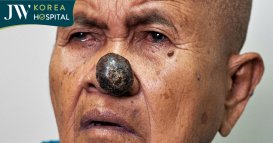 Sư bà Khơ-me mắc khối u ác tính chèn ép đường thở ở tuổi 80 cuối đời