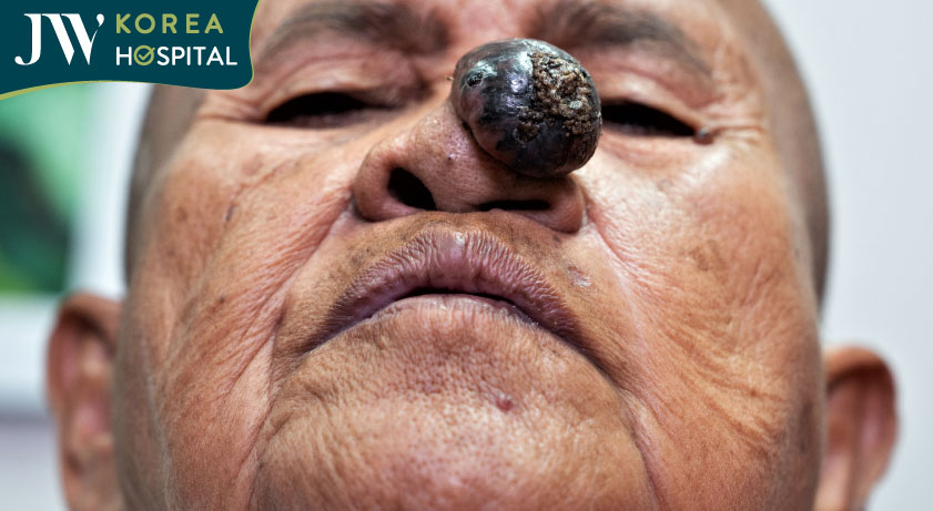 Cụ bà khơ-me 80 tuổi bị mắc khối u ngay mũi suốt 2 năm