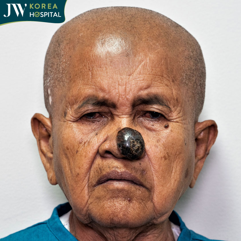 Hình ảnh cụ bà Khơ-me 80 tuổi mắc khối u ở mũi