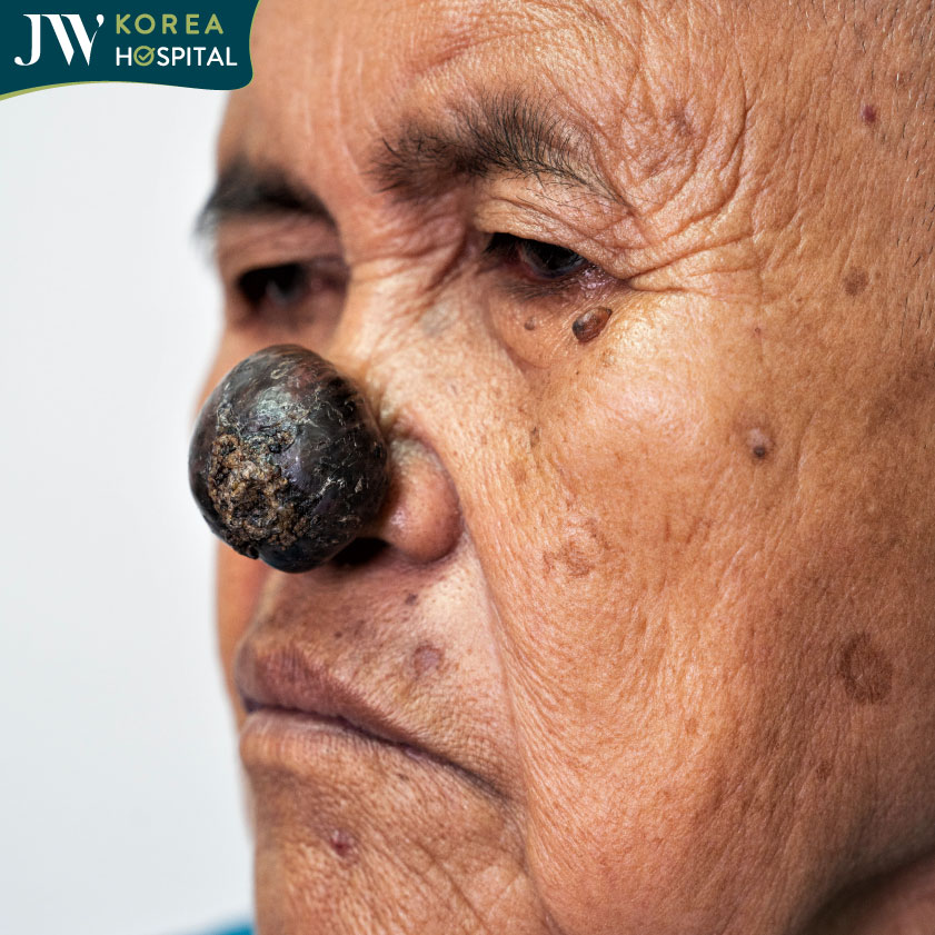 Khối u ở mũi khiến cụ bà khó thở và gây cản trở trong sinh hoạt hằng ngày suốt 2 năm