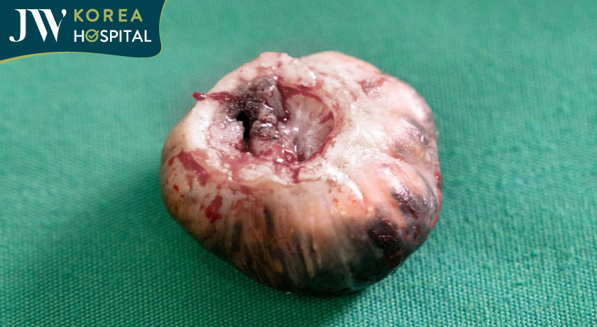 Khối u của sư bà 80 tuổi được cắt bỏ thành công