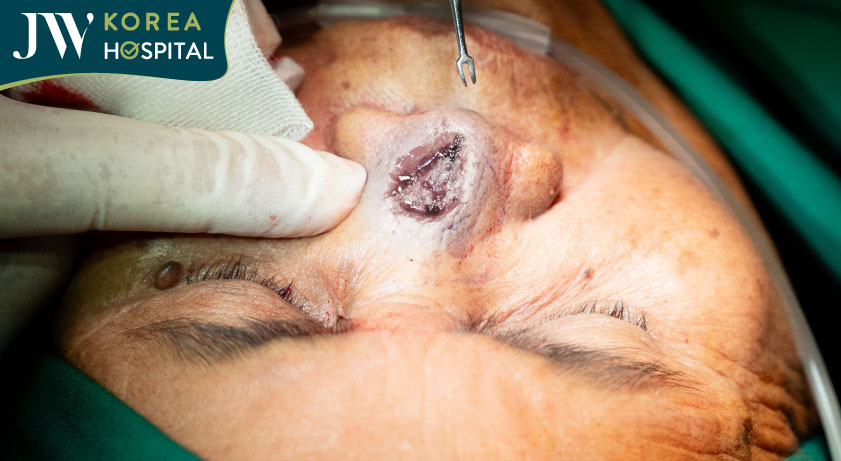 Hình ảnh cụ bà được cắt bỏ khối u thành công bở bác sĩ Tú Dung và ê-kíp JW