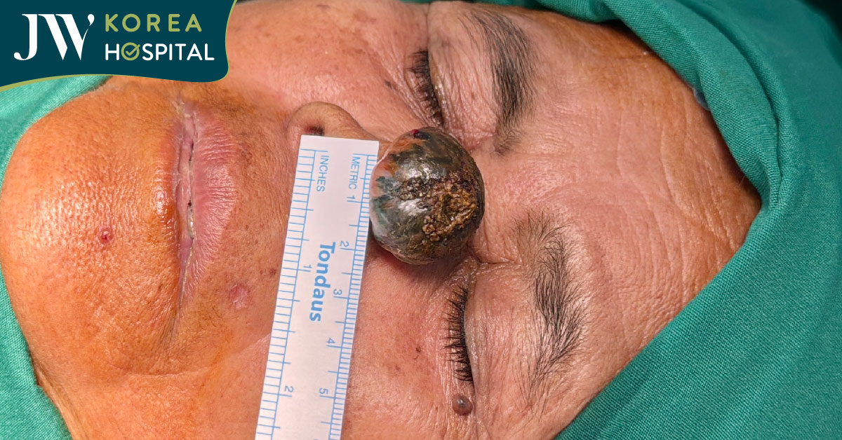 Sư bà Khơ-me 80 tuổi được bác sĩ Tú Dung mổ khối u ác tính ăn mòn mũi miễn phí