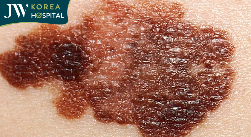 Melanoma là khối u ác tính do hắc sắc tố hình thành nên