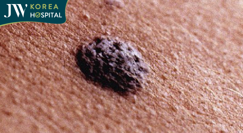 Xuất hiện nốt ruồi bất thường là dấu hiệu của khối u ác tính Melanoma