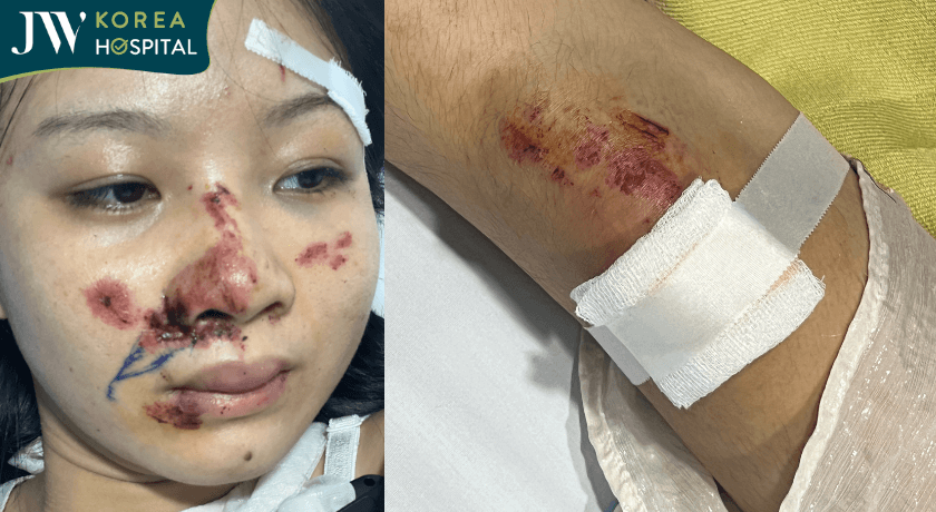 chấn thương vùng mặt cả vùng chân nặng nề