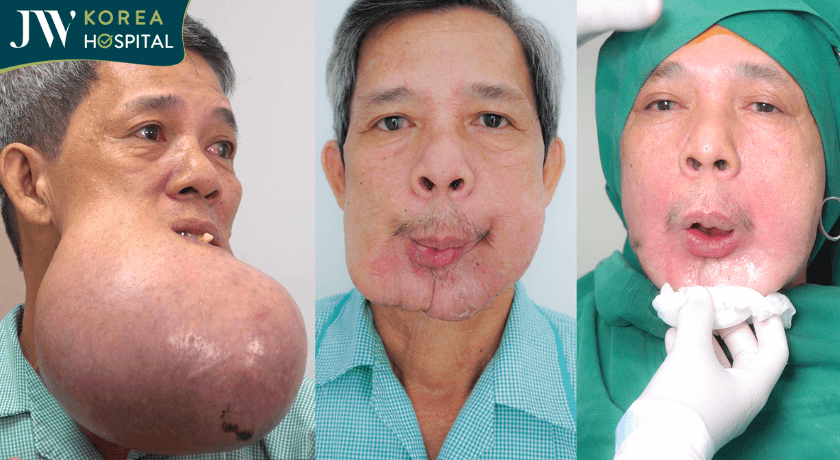 Chú khanh khối U khổng lồ quá trình phẫu thuật điều trị tại JW