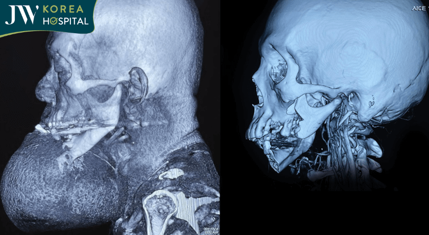 Chú Khanh hình chụp MRI trước và sau phẫu thuật cắt U