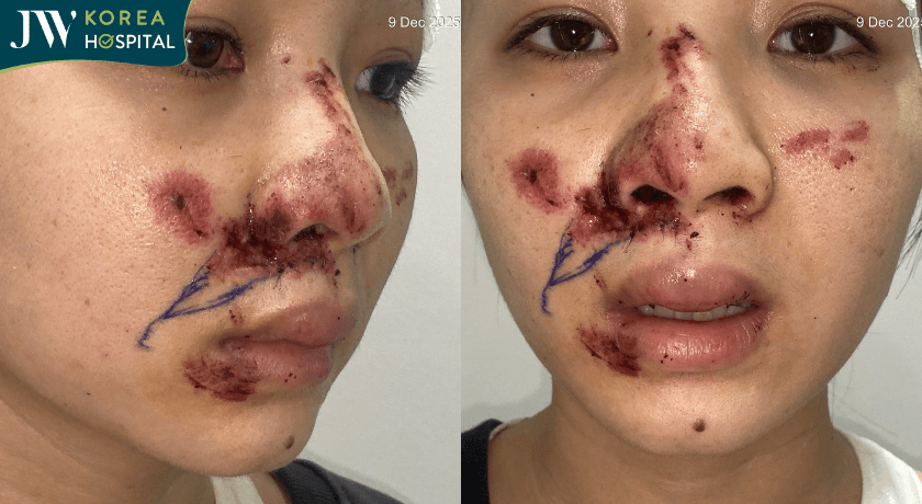 cô gái gen Z tai nạn giao thông nát mặt