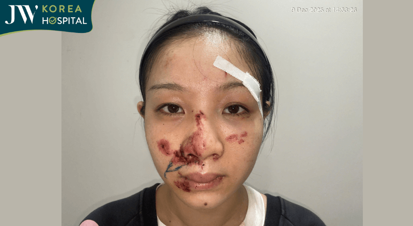 cô gái tai nạn giao thông bị chấn thương vùng mặt tìm đến bệnh viện jw
