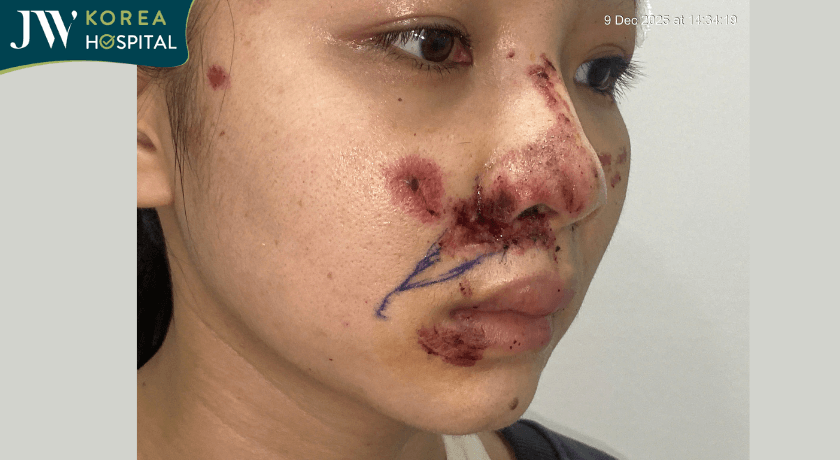 cô gái bị tai nạn giao thông chấn thương nặng vùng mặt