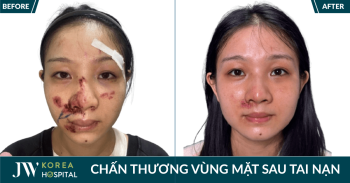Cô gái trẻ điều trị chấn thương vùng mặt sau tai nạn giao thông tại Bệnh viện JW