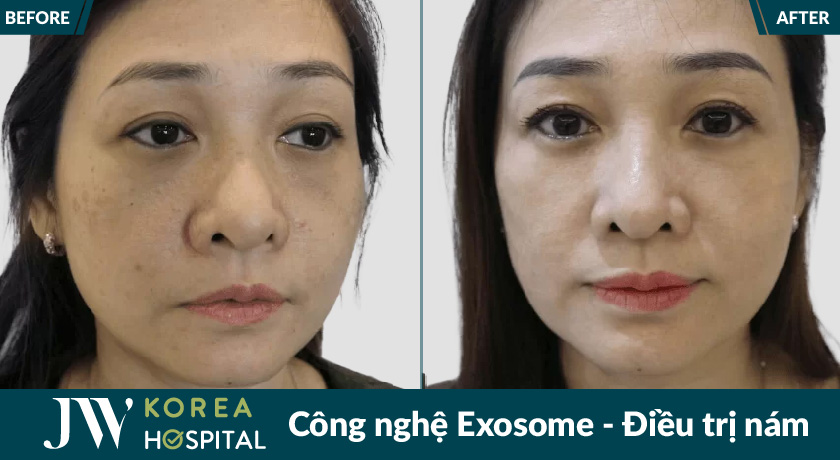 công nghệ Exosome điều trị nám