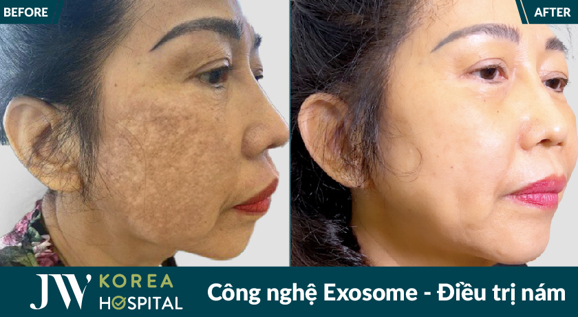 công nghệ Exosome điều trị nám