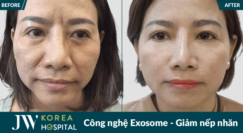công nghệ Exosome giảm nếp nhăn, cải thiện làn da lão hóa