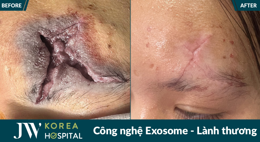 công nghệ Exosome làm lành vết thương hở