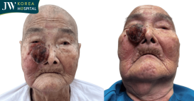 cụ bà 93 tuổi bị khối U máu trên mặt