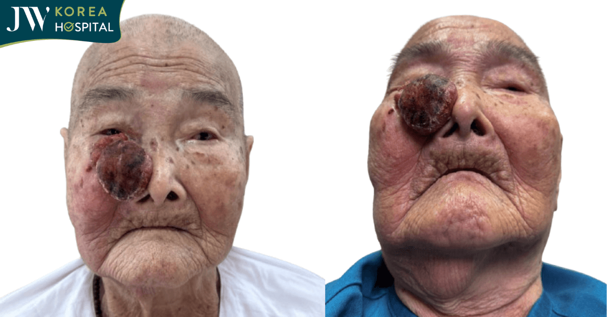 Cứu sống cụ bà 93 tuổi bị suy tim nặng mang khối u máu lở loét ăn sát vào mắt