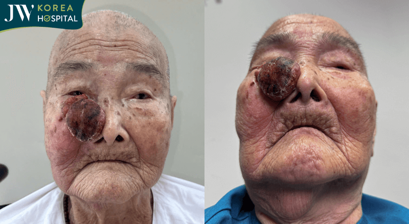 cụ bà 93t đến JW cầu cứu bác sĩ Tú Dung cắt khối u máu