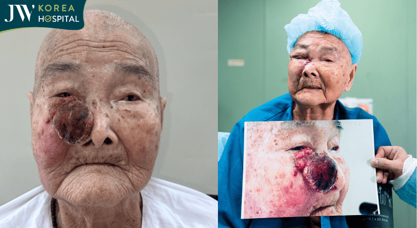 cụ bà trước và sau khi cắt Khối U máu trên mặt