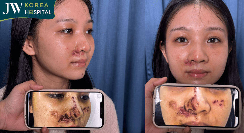 hình ảnh trước và sau 10 ngày điều trị tại JW