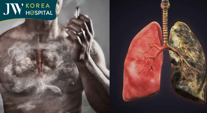 Hút thuốc lá gây ung thư phổi