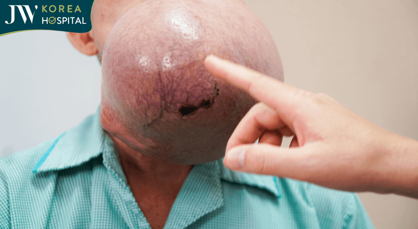 khối U bắt đầu rỉ máu nghiêm trọng