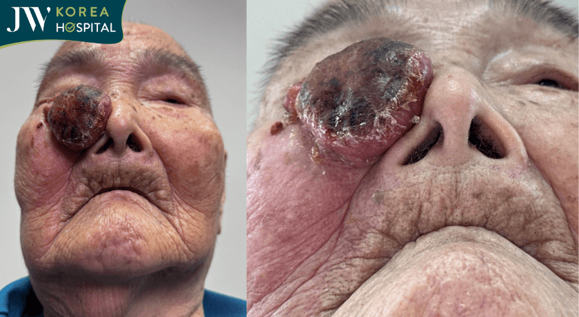 cụ bà 93t khối u lấn sát vào mắt