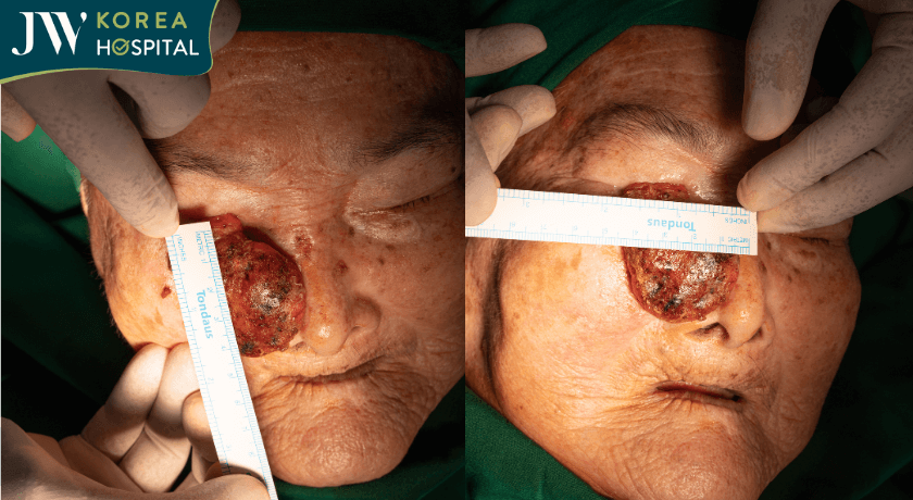 kích thước khối u máu của cụ bà 93 tuổi